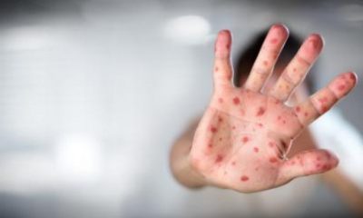 Număr record de cazuri de rujeolă în Europa
