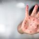 Număr record de cazuri de rujeolă în Europa