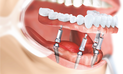 Avantajele implanturilor dentare moderne