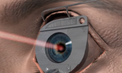 Se poate trata astigmatismul cu operatie laser?