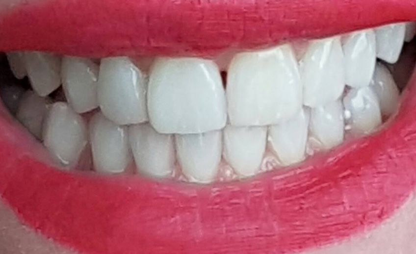 Secretul dintilor care nu se pateaza