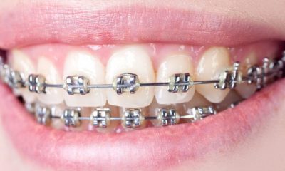 De ce ai nevoie de un aparat dentar