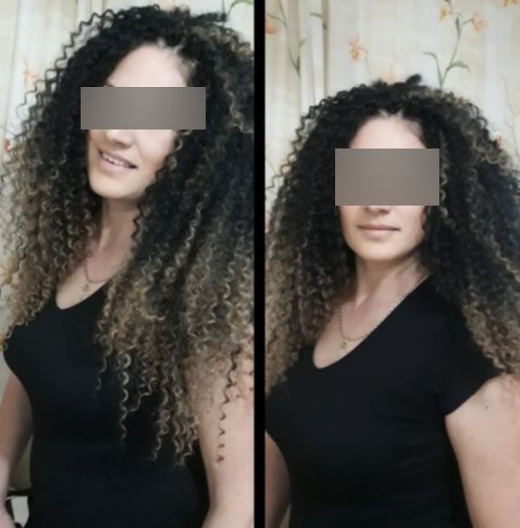 FOTO. Cum arătau plămânii femeii din Alba care a murit de Covid-19 la doar 39 de ani, deși nu avea alte boli
