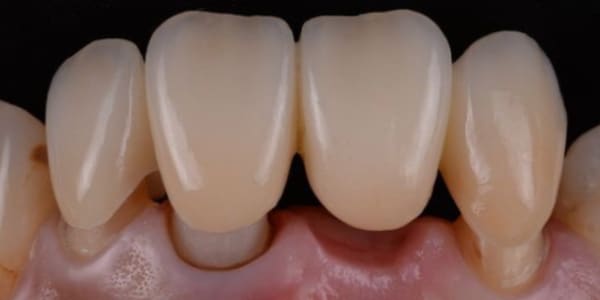 Coroana dentara la mare cautare