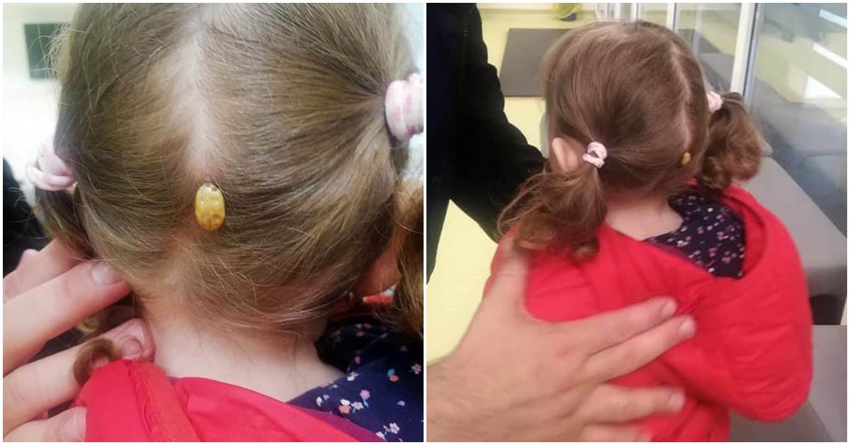 Căpușă uriașă descoperită pe scalpul unei fetițe din Suceava. Copilul a fost dus urgent la spital