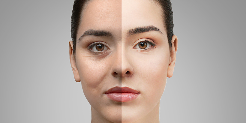Avantajele oferite de operatia de blefaroplastie