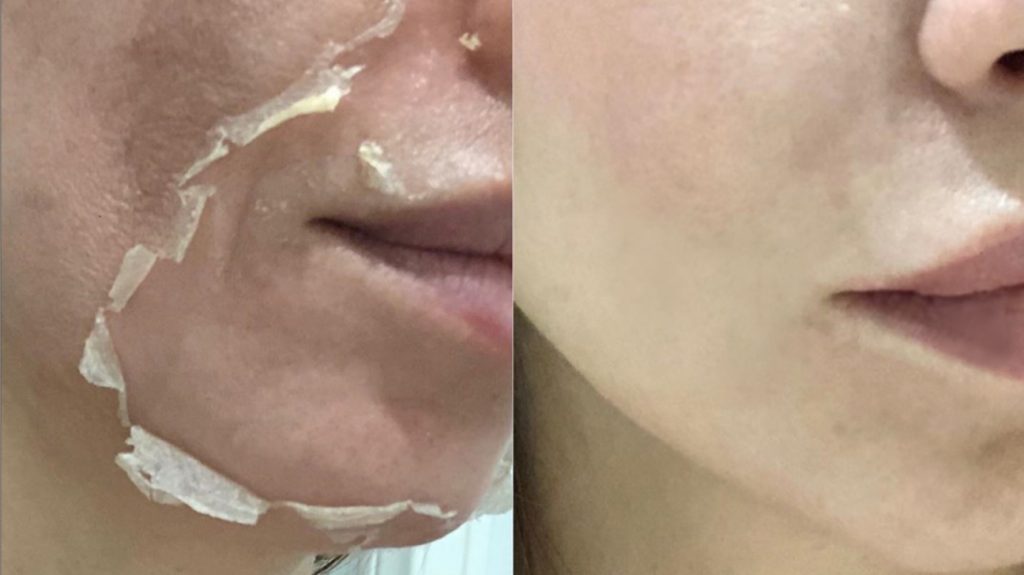 Mituri despre peelingul chimic si adevarul din spatele lor
