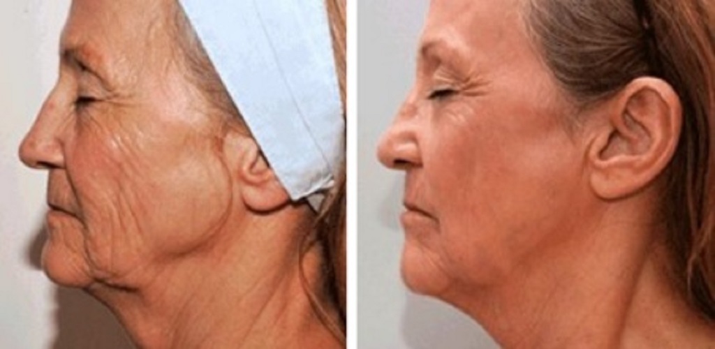 Rejuvenarea facială cu laserul CO2 – beneficii