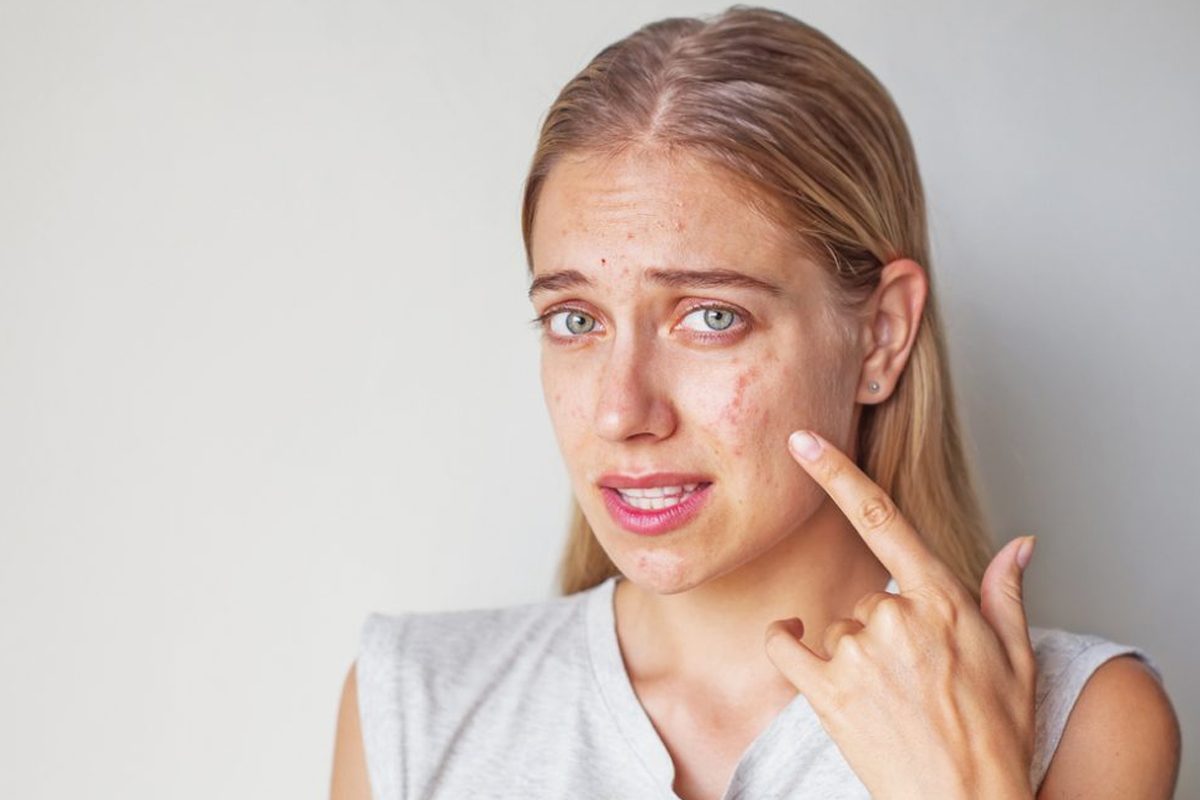 Ce este important de stiut despre acneea la adulti