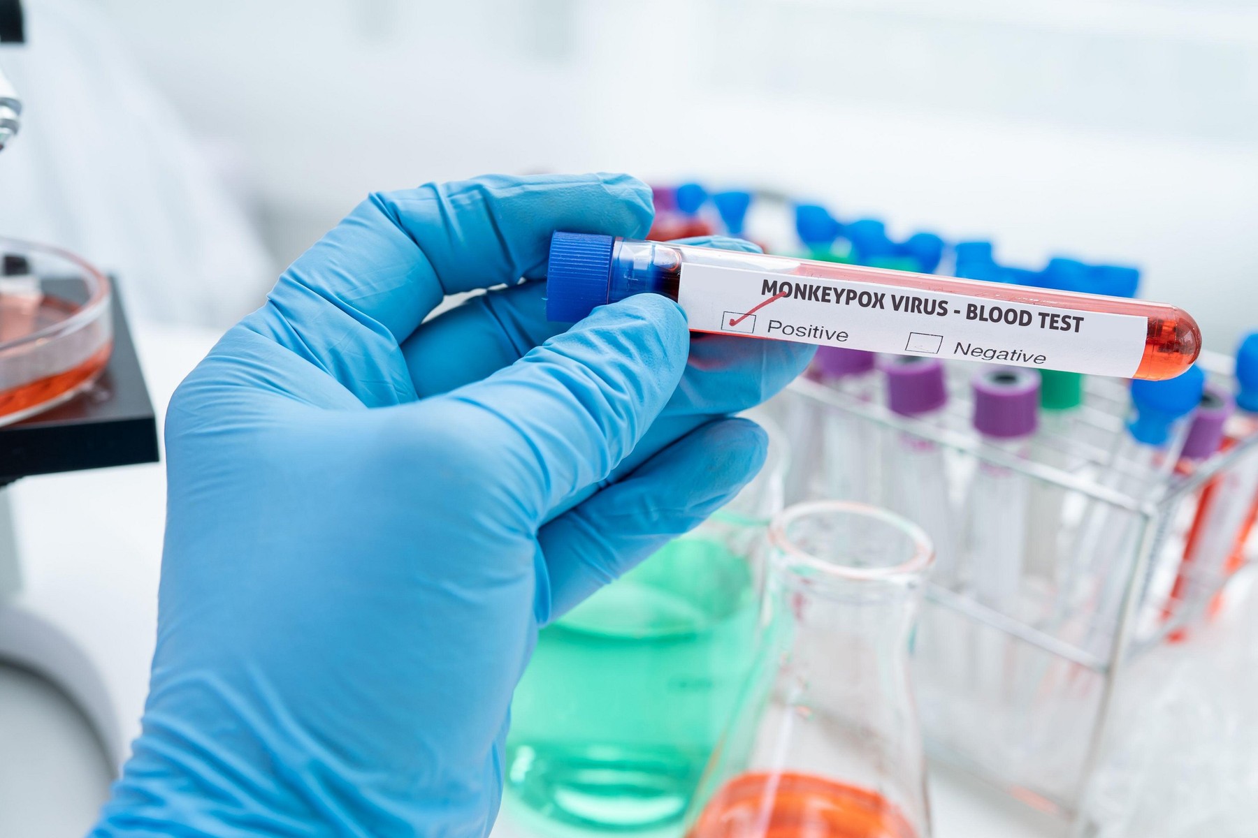 România a primit 5.060 doze de vaccin împotriva variolei maimuţei. Care sunt persoanele eligibile și când se administrează vaccinul