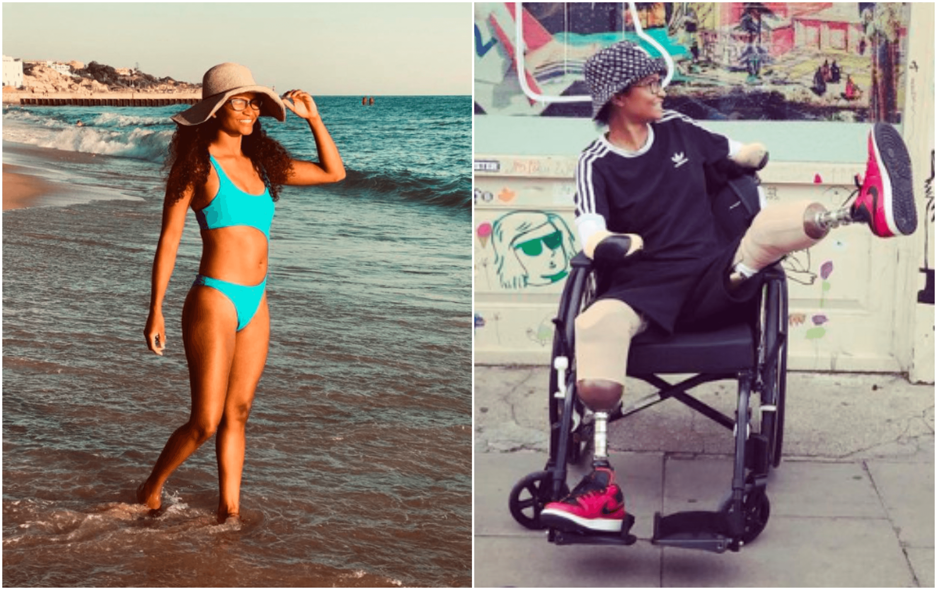 O dansatoare a rămas fără mâini și picioare după ce a fost mușcată de un țânțar în vacanță