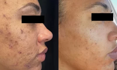 Inovație în lumea dermatologiei: SwissMED Clinic a adus cel mai performant laser pentru tratamentul acneei – AVICLEAR