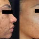 Inovație în lumea dermatologiei: SwissMED Clinic a adus cel mai performant laser pentru tratamentul acneei – AVICLEAR