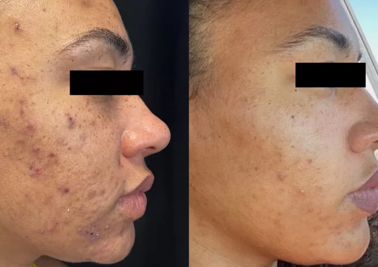 Inovație în lumea dermatologiei: SwissMED Clinic a adus cel mai performant laser pentru tratamentul acneei – AVICLEAR