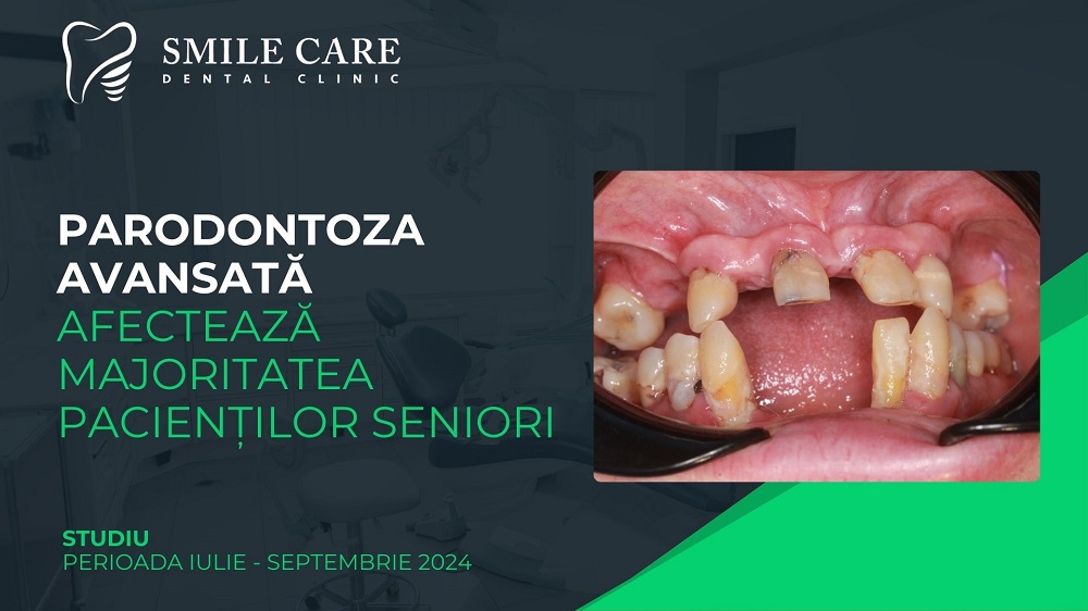 Studiu Smile Care: parodontoza avansată afectează majoritatea pacienților seniori, iar proteza fixă pe implanturi este soluția preferată