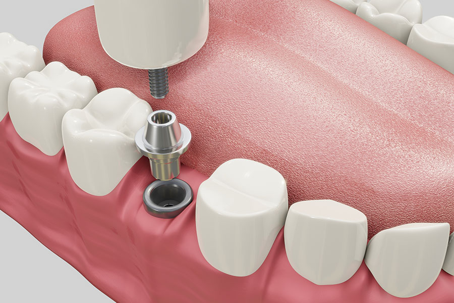 Protezare vs implantare dentară: care variantă este mai bună? Protezare vs implantare dentară: care variantă este mai bună?