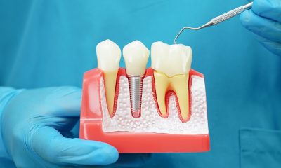 Descoperă cele mai noi proceduri de endodonție disponibile în Constanța