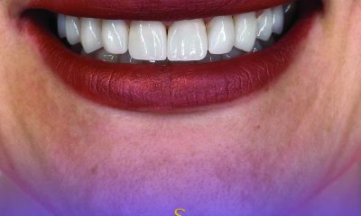Implant dentar: Cele mai frecvente întrebări și răspunsuri utile