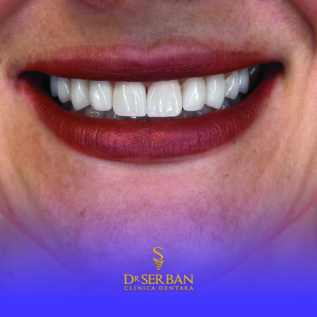 Implant dentar: Cele mai frecvente întrebări și răspunsuri utile