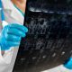 Neurochirurgia spinală – soluții pentru coloană