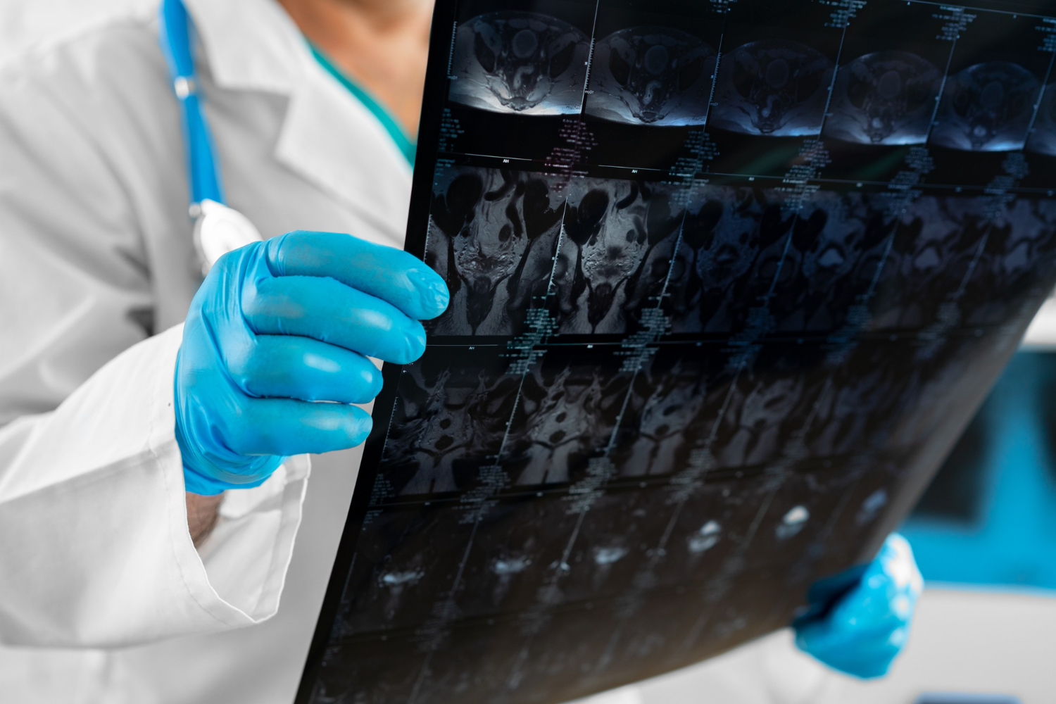 Neurochirurgia spinală – soluții pentru coloană Neurochirurgia spinală – soluții pentru coloană