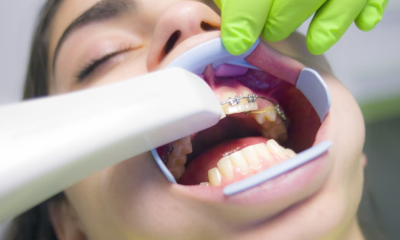 Etapele tratamentului cu aparat dentar
