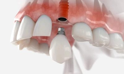 Ce conține un plan de tratament pentru implant dentar