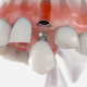 Ce conține un plan de tratament pentru implant dentar