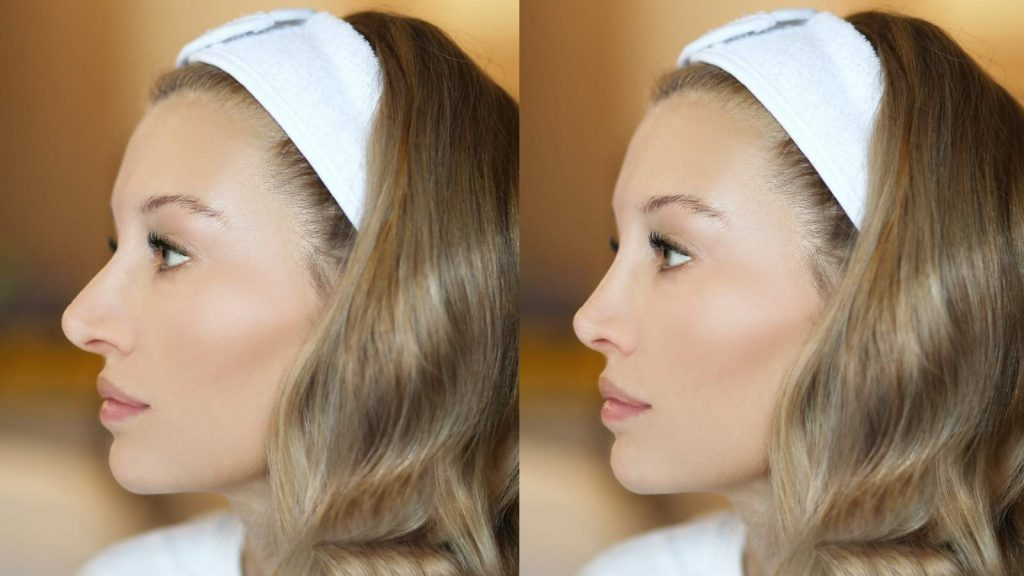 Tipuri de rinoplastie și ce implică fiecare etapă