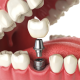 Implantul dentar explicat materiale, opțiuni și etape generale