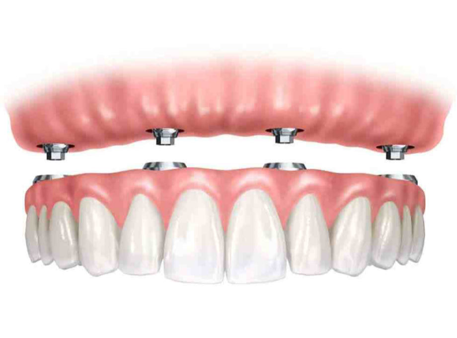 De ce diferă costul implantului dentar de la o clinică la alta