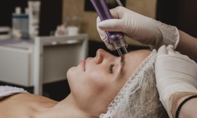 Excizia alunițelor cu laserul CO2: Cum funcționează, avantaje și ce trebuie să știi înainte de procedură