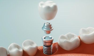 Principalele probleme provocate de pierderea dintilor si care sunt beneficiile oferite de implantul dentar