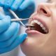 Totul Despre Procedura de Implant Dentar în Constanța