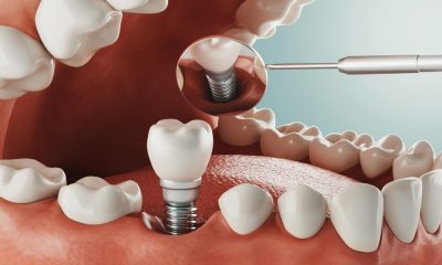 Motivele pentru care implanturile dentare Straumann sunt considerate in categoria premium si pentru care sunt printre cele mai apreciate de catre medicii stomatologi