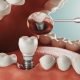 Motivele pentru care implanturile dentare Straumann sunt considerate in categoria premium si pentru care sunt printre cele mai apreciate de catre medicii stomatologi