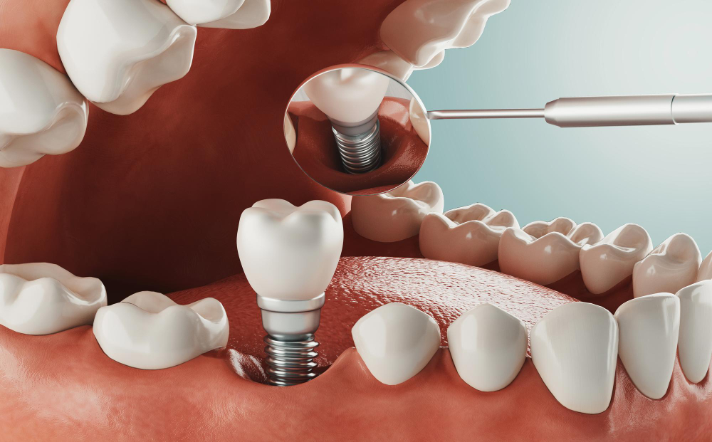 Motivele pentru care implanturile dentare Straumann sunt considerate in categoria premium si pentru care sunt printre cele mai apreciate de catre medicii stomatologi
