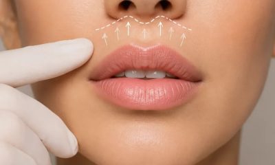 Lip Lift: ce este intervenția care poate modifica proporțiile buzei superioare