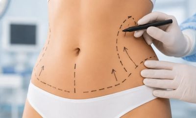 Ce Rezultate Poți Obține Prin Liposucție