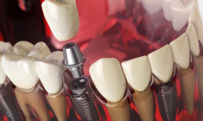 Implantul dentar Straumann – de ce este considerat un implant premium și când este alegerea potrivită