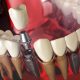 Implantul dentar Straumann – de ce este considerat un implant premium și când este alegerea potrivită