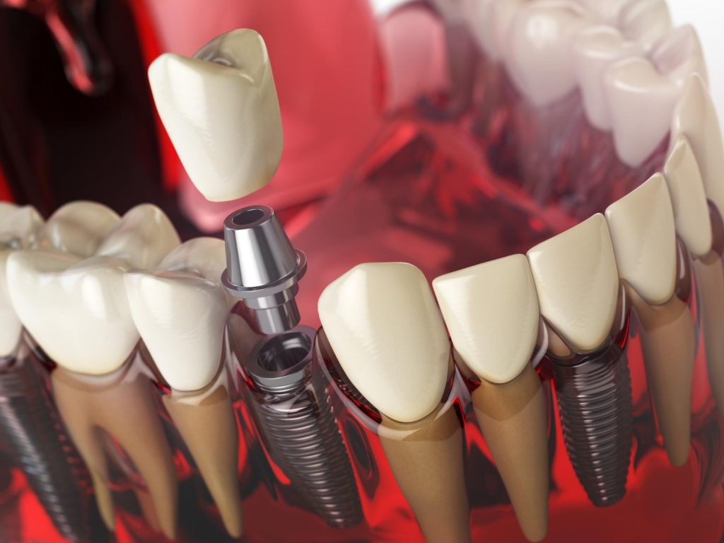 Implantul dentar Straumann – de ce este considerat un implant premium și când este alegerea potrivită